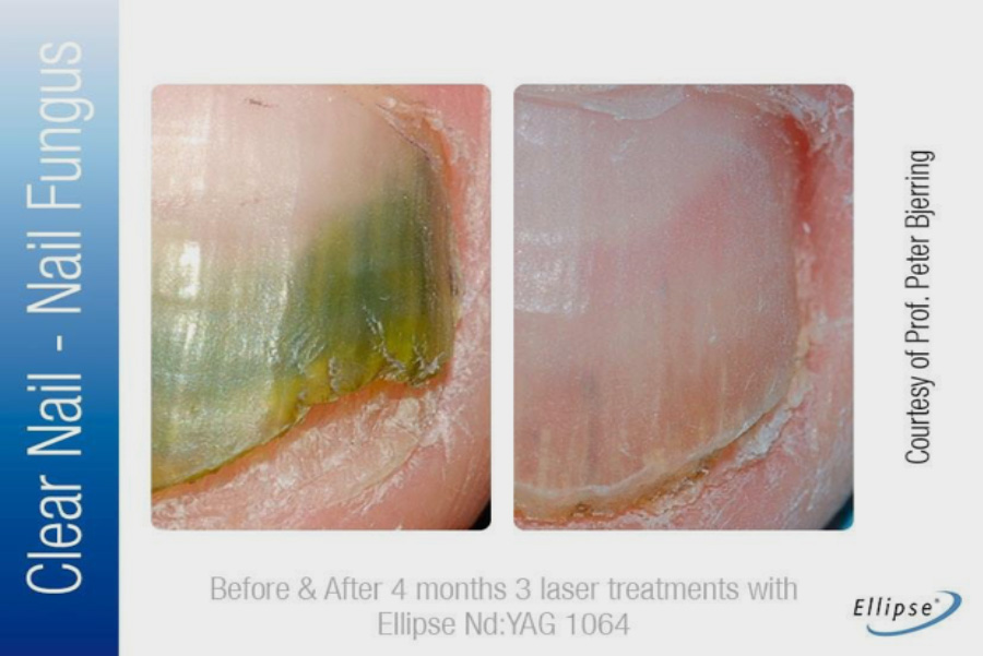 Laser Nail Fungus & Wart Treatment 2