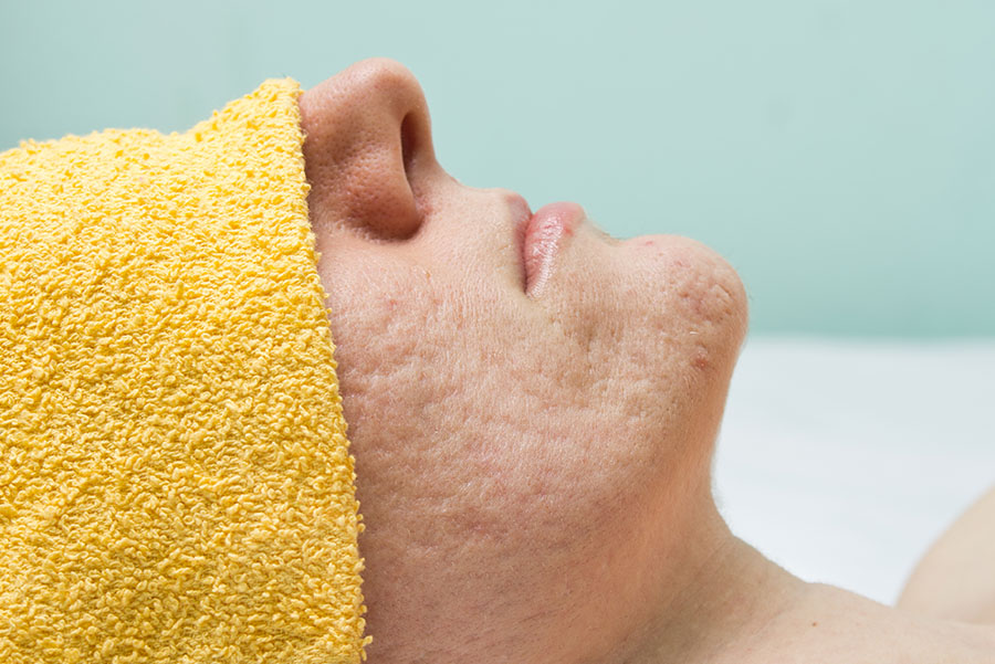 Laser Scar - Stretch Mark Treatment copy