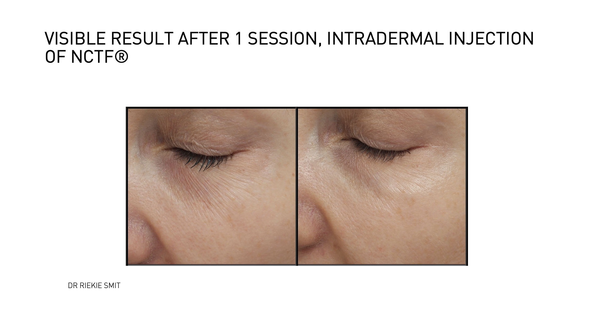 Mesotherapy 1