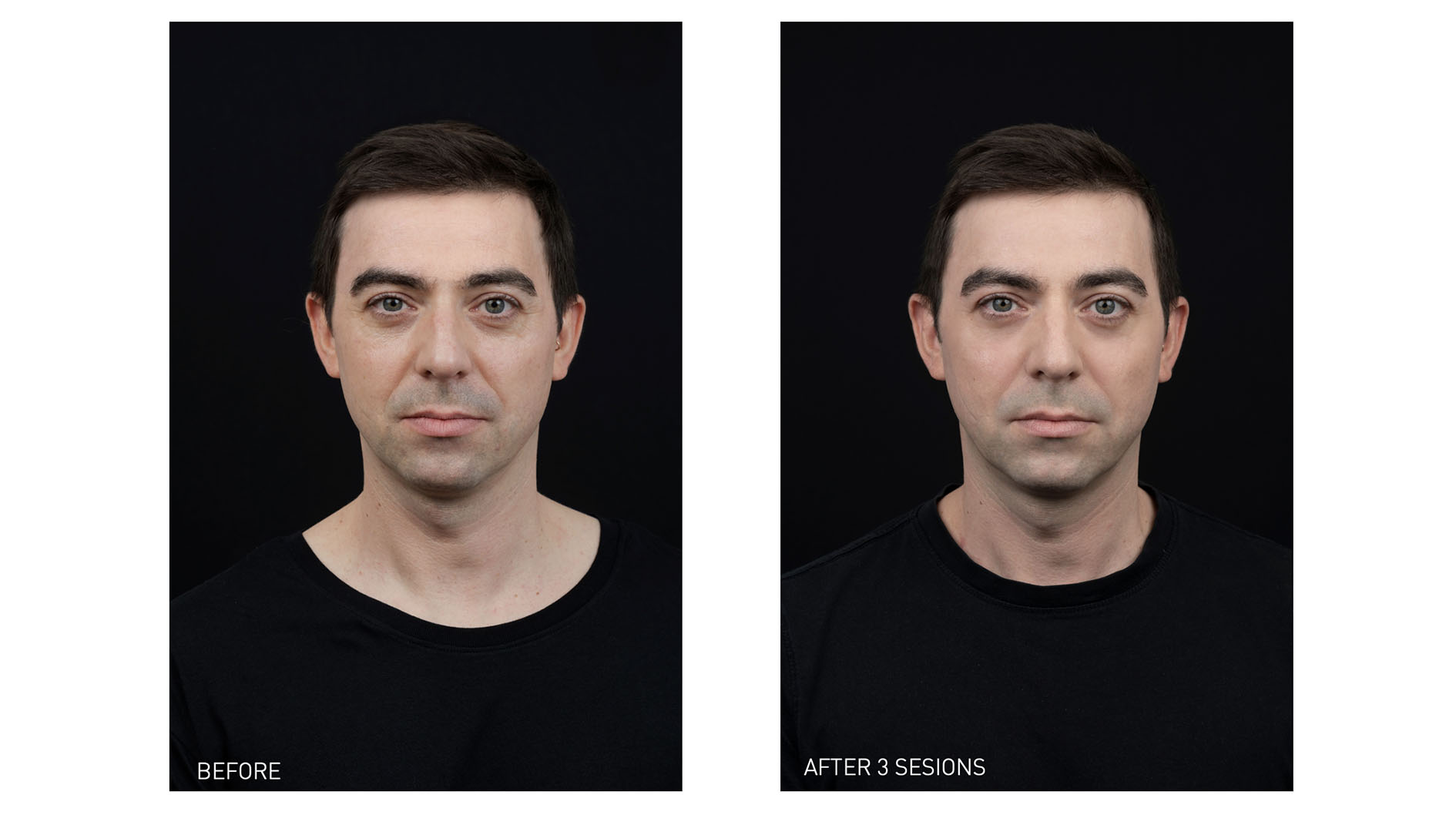 Mesotherapy 2