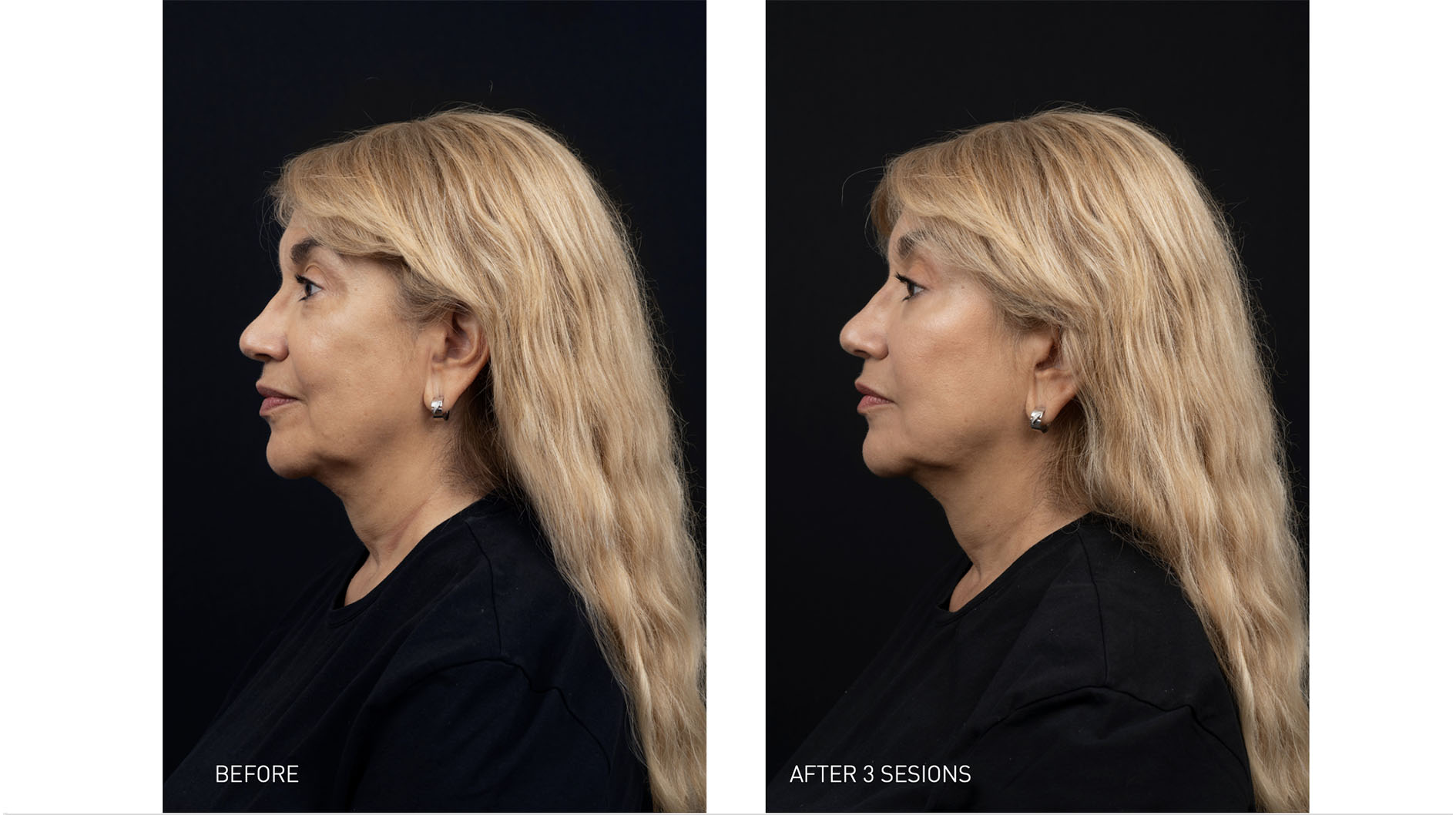 Mesotherapy 4