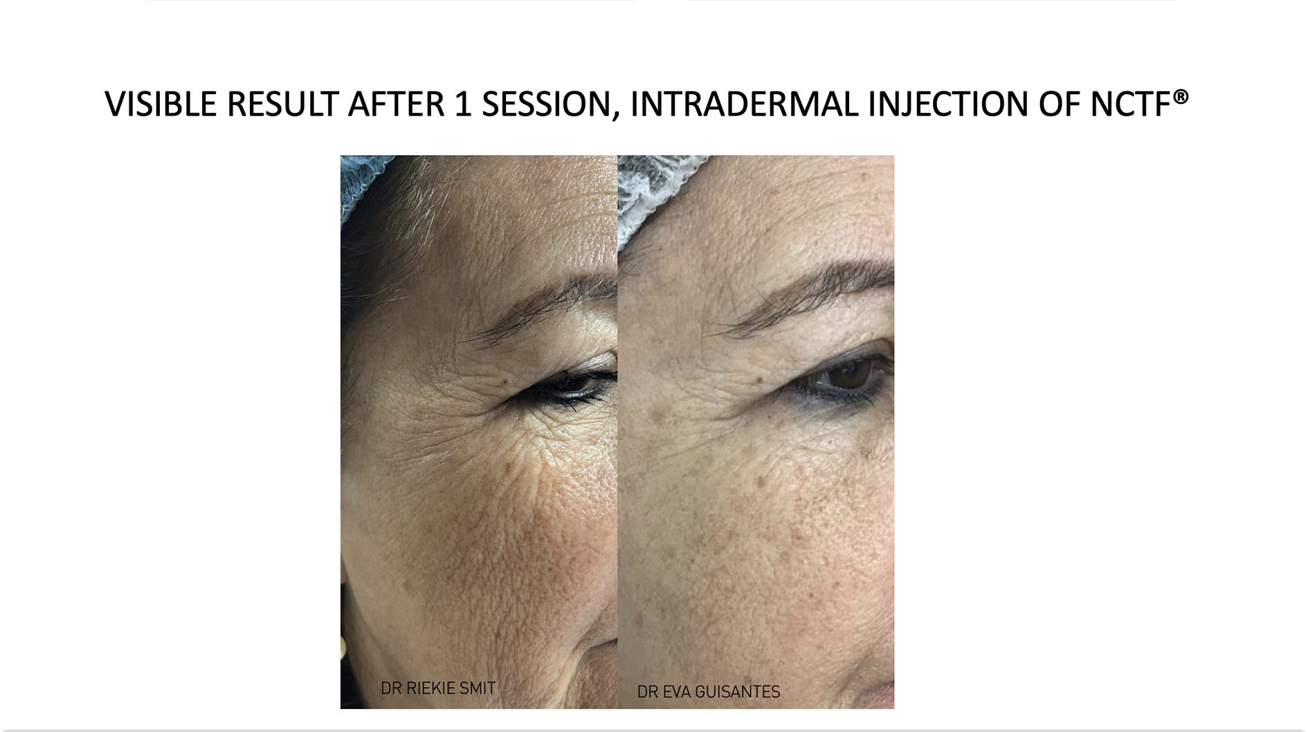 Mesotherapy 5