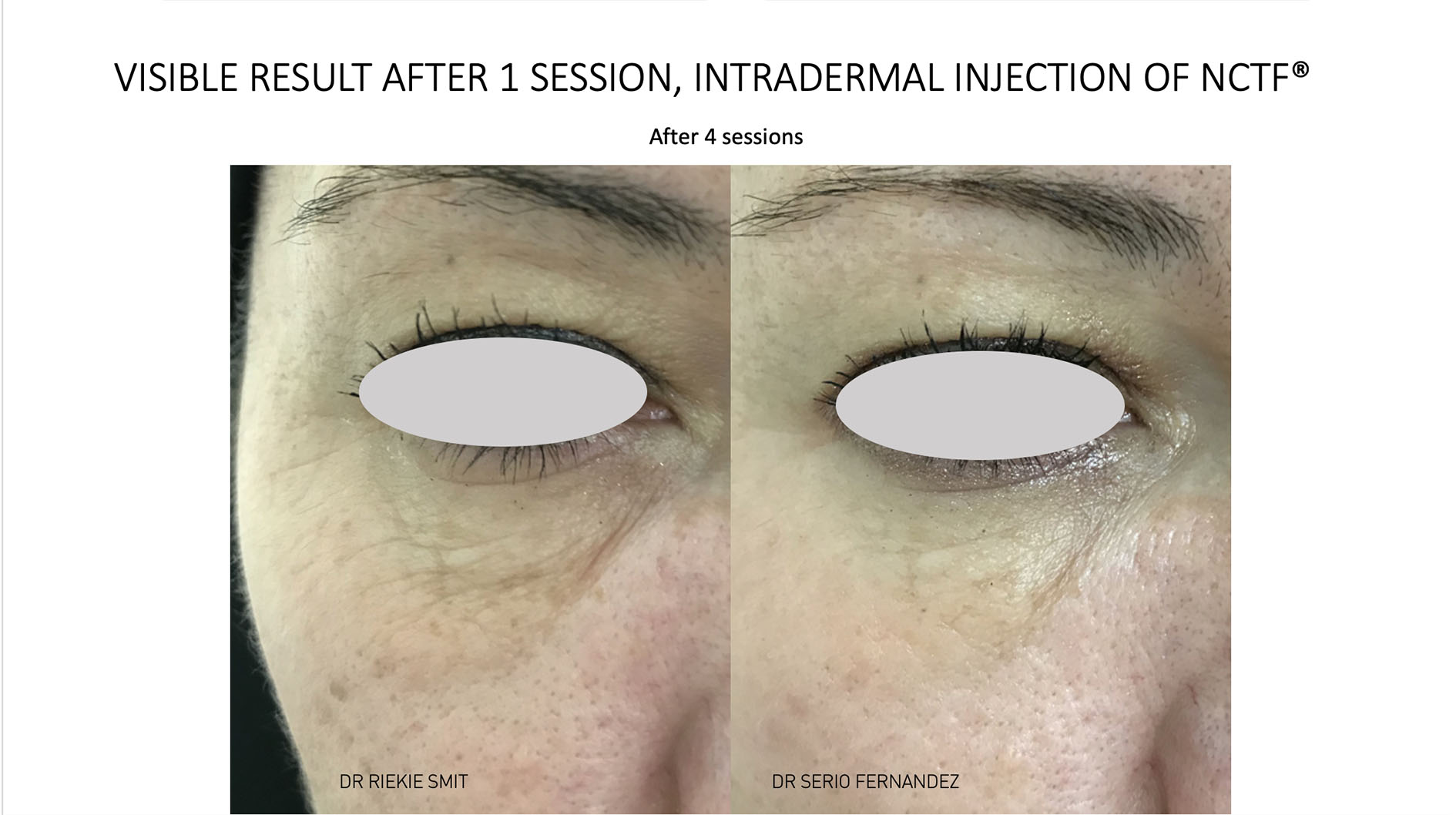 Mesotherapy 6