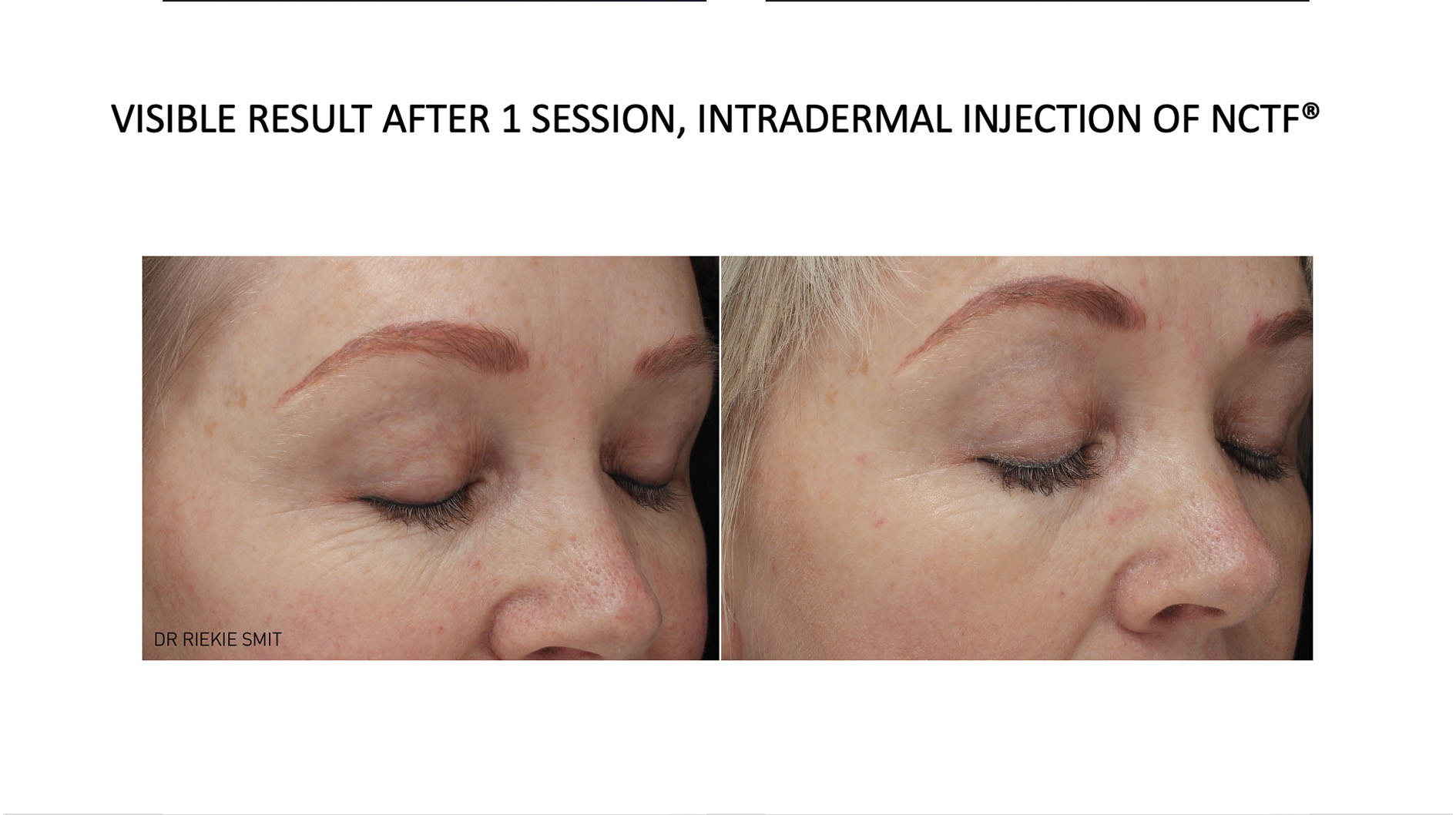 Mesotherapy 7