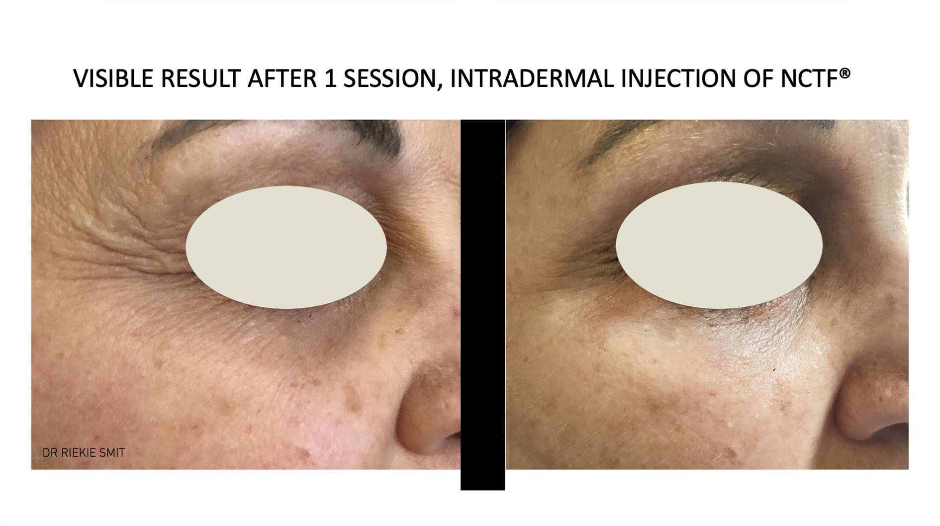 Mesotherapy 8