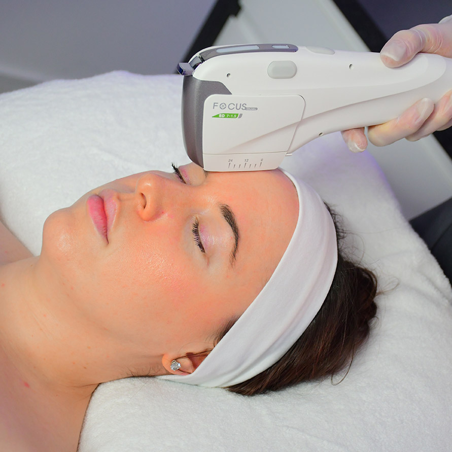 HIFU Treatment on Ladies Forehead copy